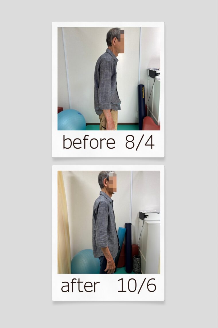 首の痛みが半年続く患者さん。2か月で痛みがほぼなくなり、姿勢も改善！